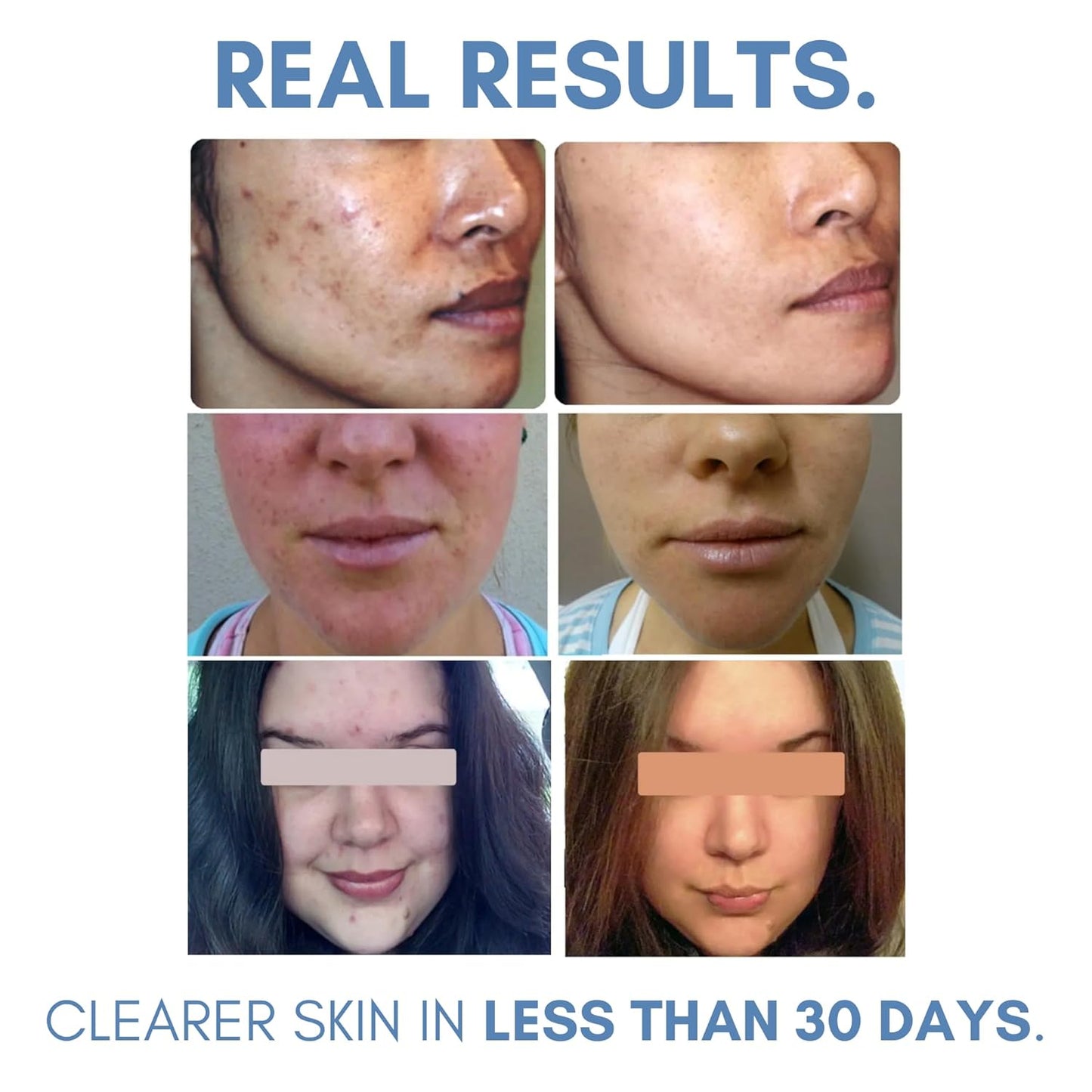 Clarifying Toner for Acne and Blemishes, Face Toner, Facial Toner, Skin Toner, Acne Toner, Toner Oily Skin, Salicylic Acid Toner, Astringent for Face, Toners, 4 Fl Oz