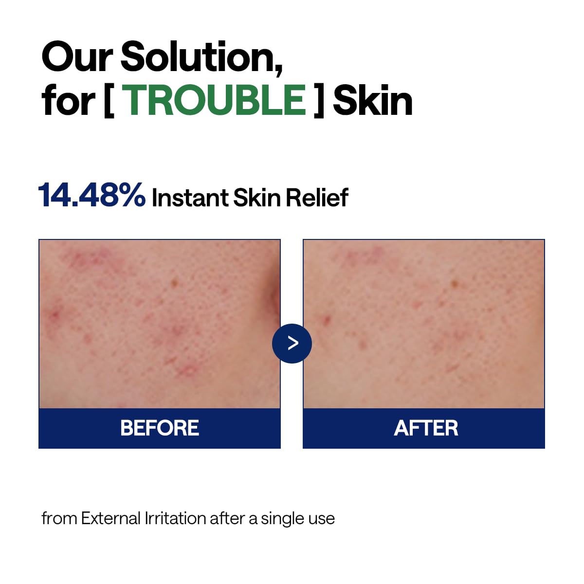 MEDIHEAL Teatree Calming Serum with Panthenol for Redness Care (1.35 fl.oz)