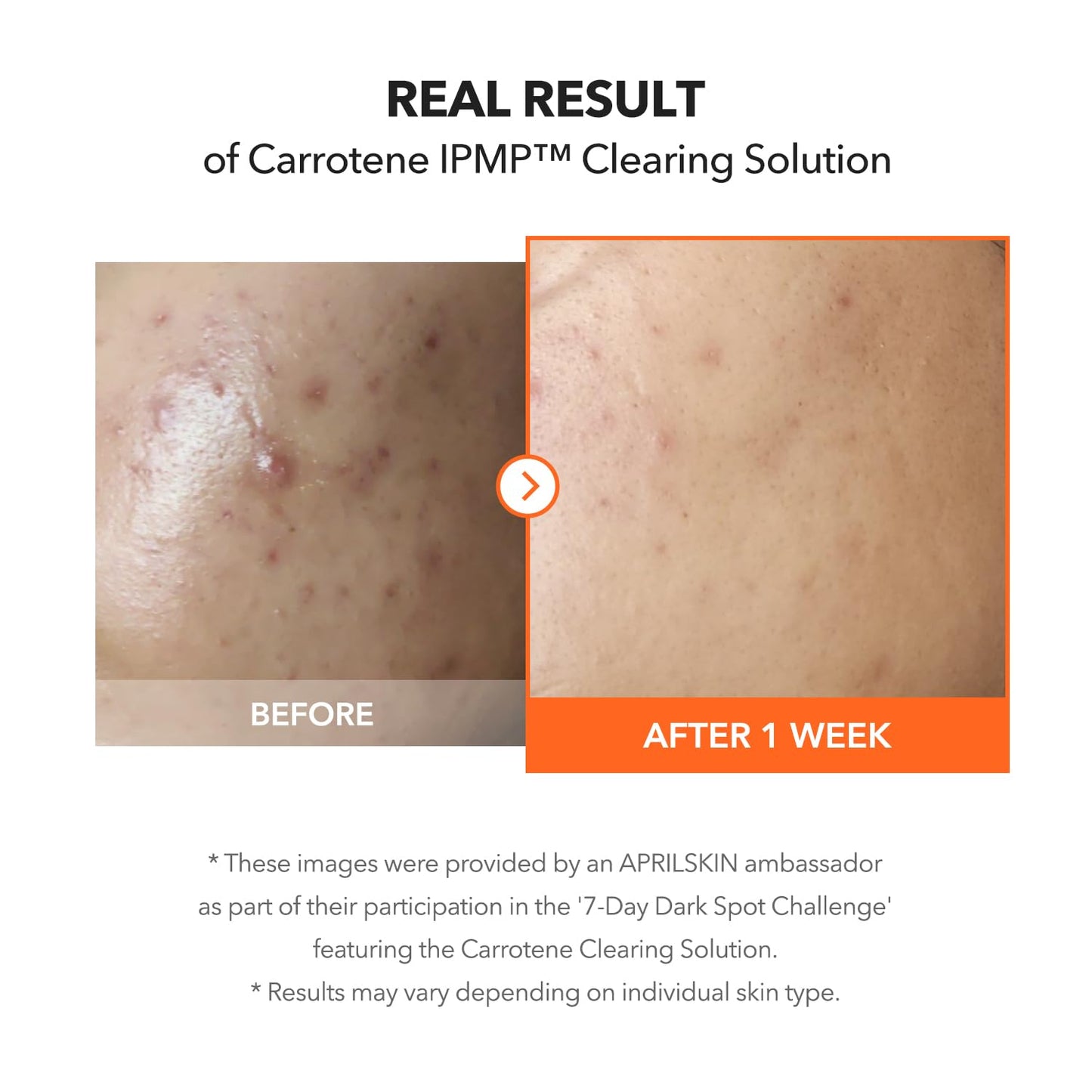 APRILSKIN Carrotene IPMP™ Clearing Solution || Quickly soothes troubled areas and helps clear blemishes | Formulated with BHA, AHA, Niacinamide & Zinc Oxide | Vegan, Cruelty-Free (0.67fl.oz.)