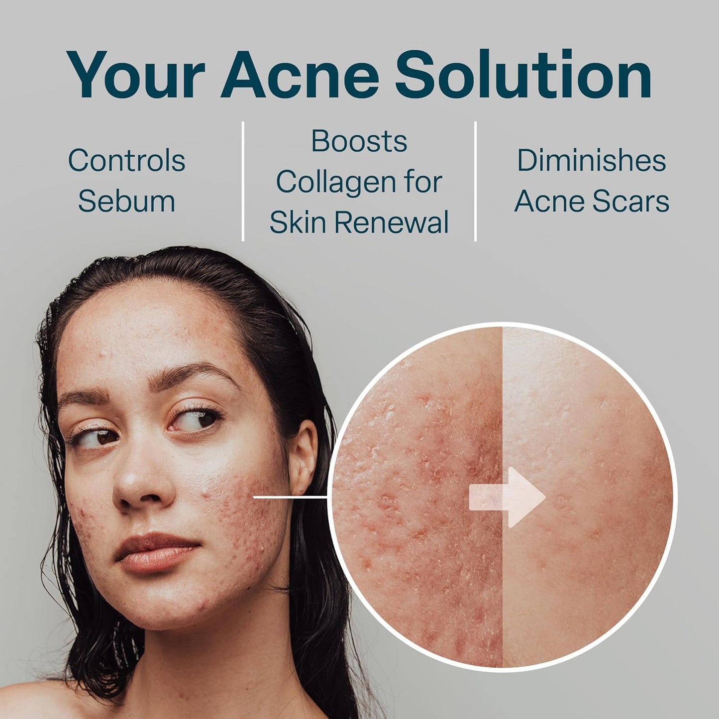 QRxLabs Glycolic/Salicylic Acid 10/2 Acne Control Pads with 10% Ultra Pure Glycolic + 2% Salicylic Acid, Allantoin, Vitamins B5, C & E, Calendula Green Tea - Most Effective Treatment Clear Skin - 2PK