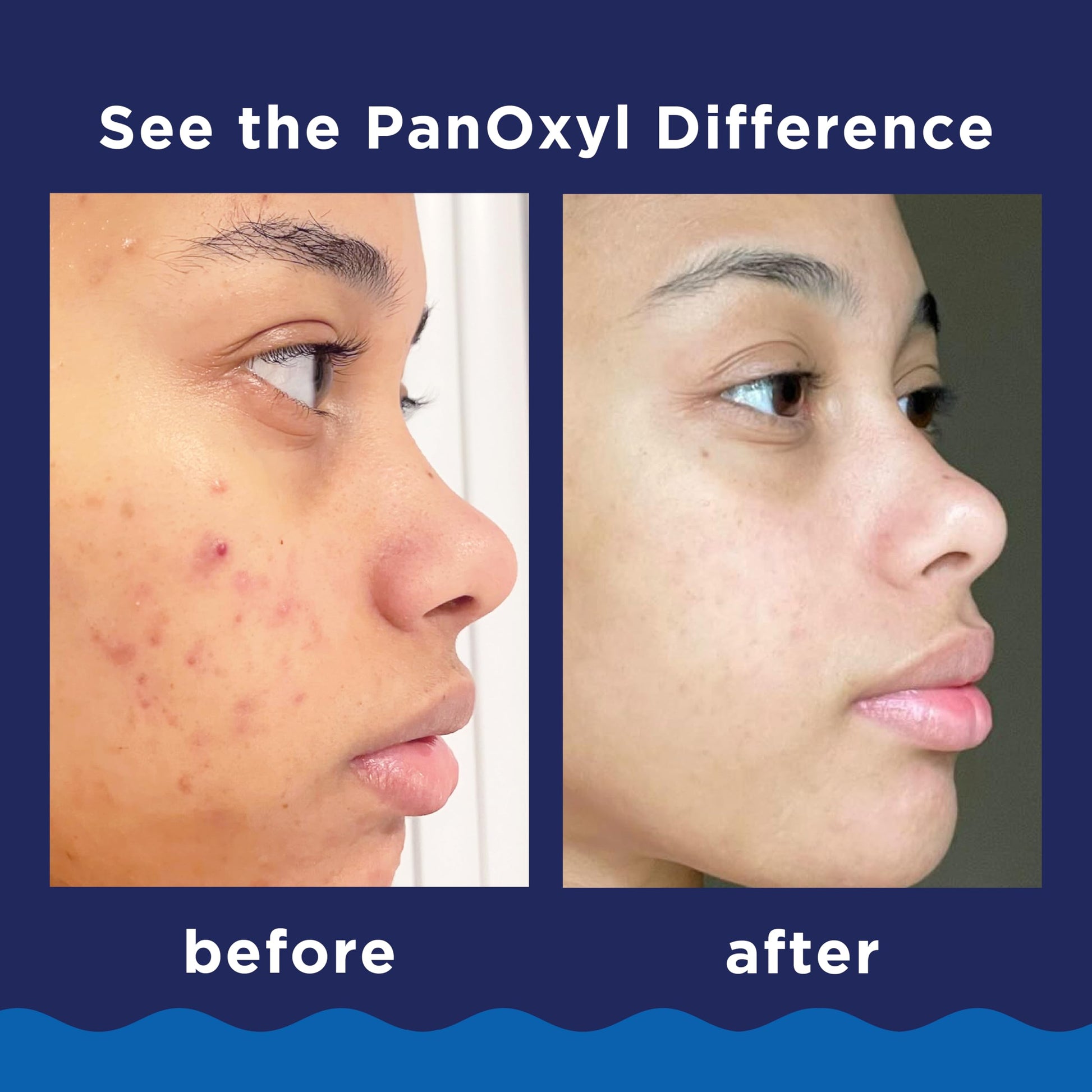 PanOxyl 10% Benzoyl Peroxide Acne Foaming Wash, Maximum Strength, Daily Acne-Fighting Face and Body