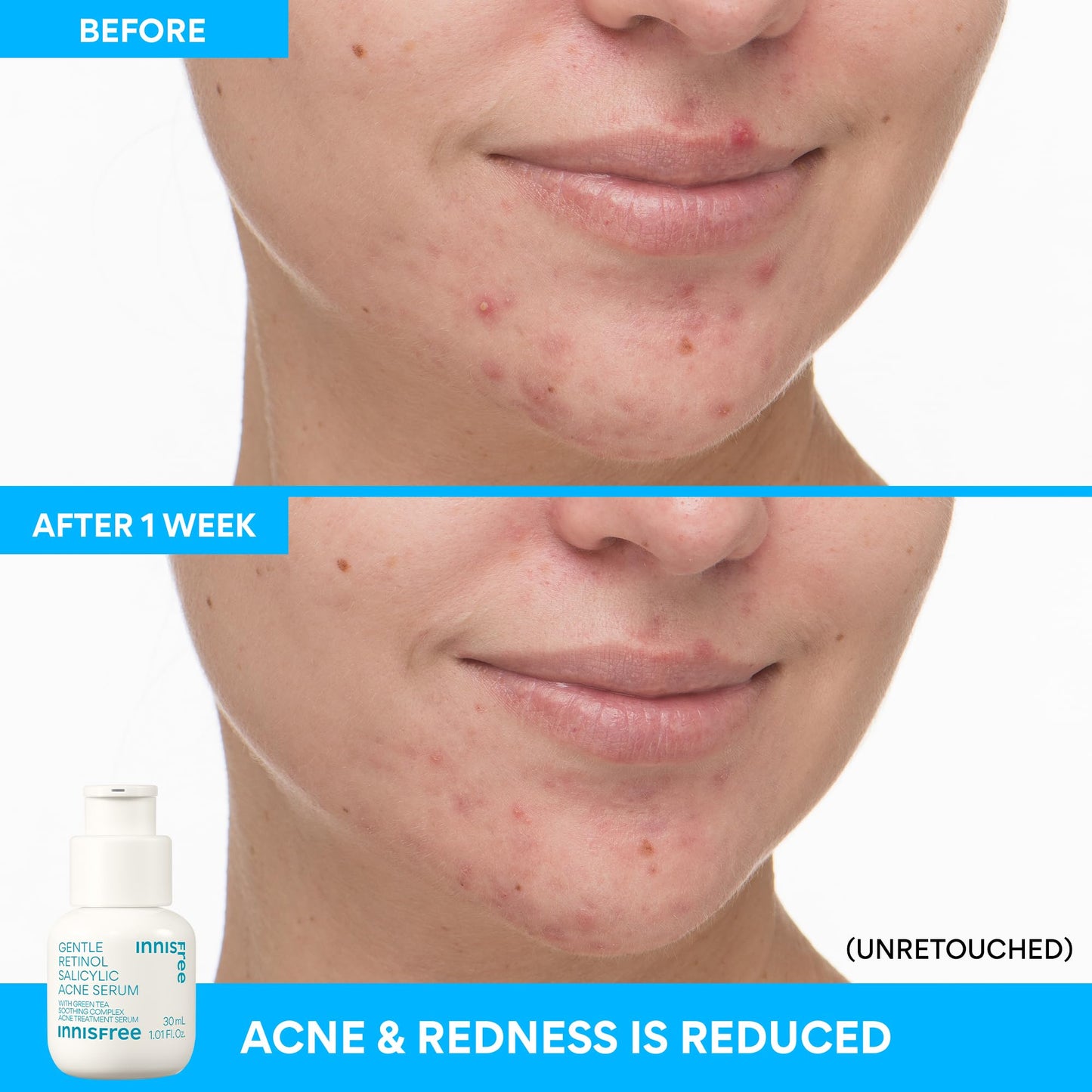 innisfree Gentle Retinol Salicylic Acne Serum | Korean Face Treatment with Niacinamide and