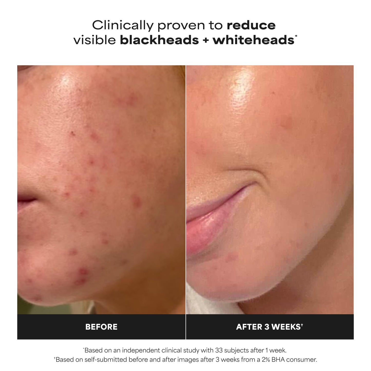 Paula's Choice SKIN PERFECTING 2% BHA Liquid Exfoliant, 4 Fl Oz