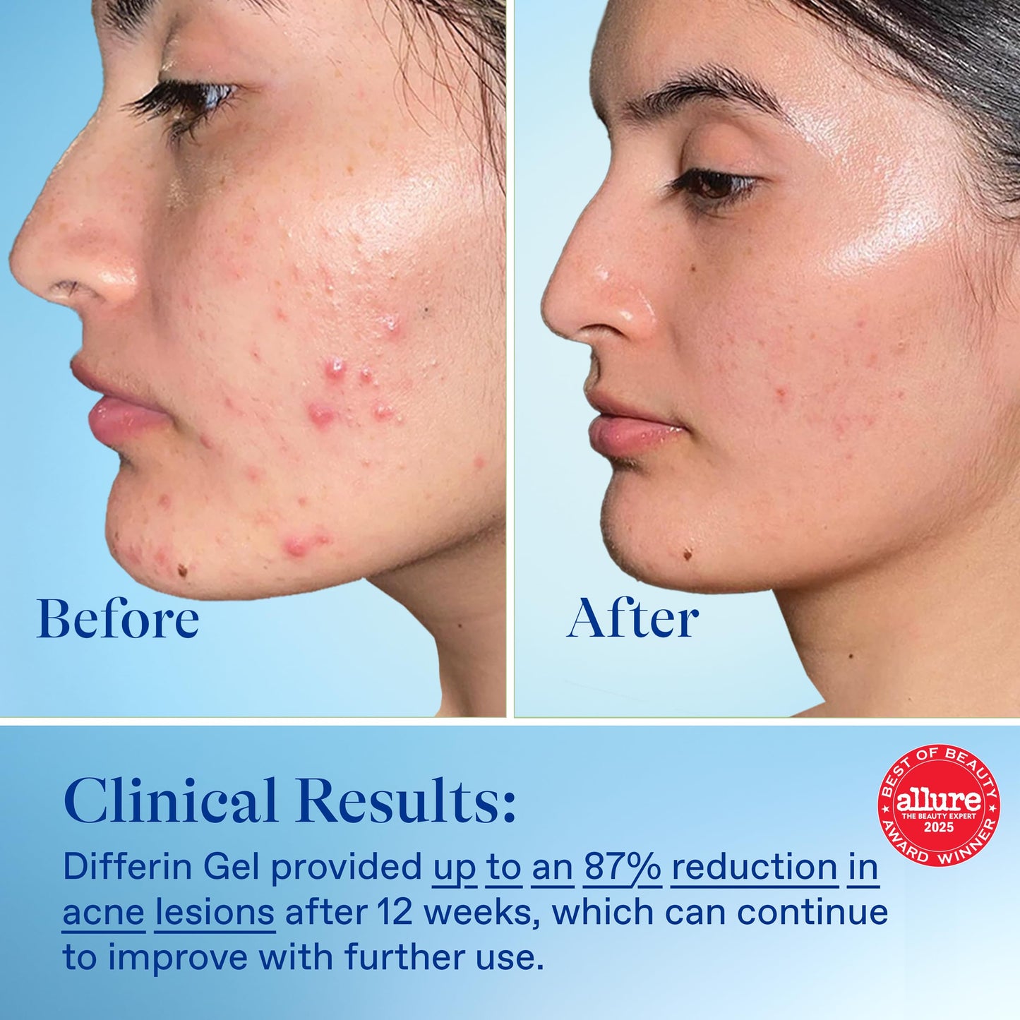 Differin Acne Retinoid Treatment Gel, 0.1% Adapalene, 15g Tube, 2ct