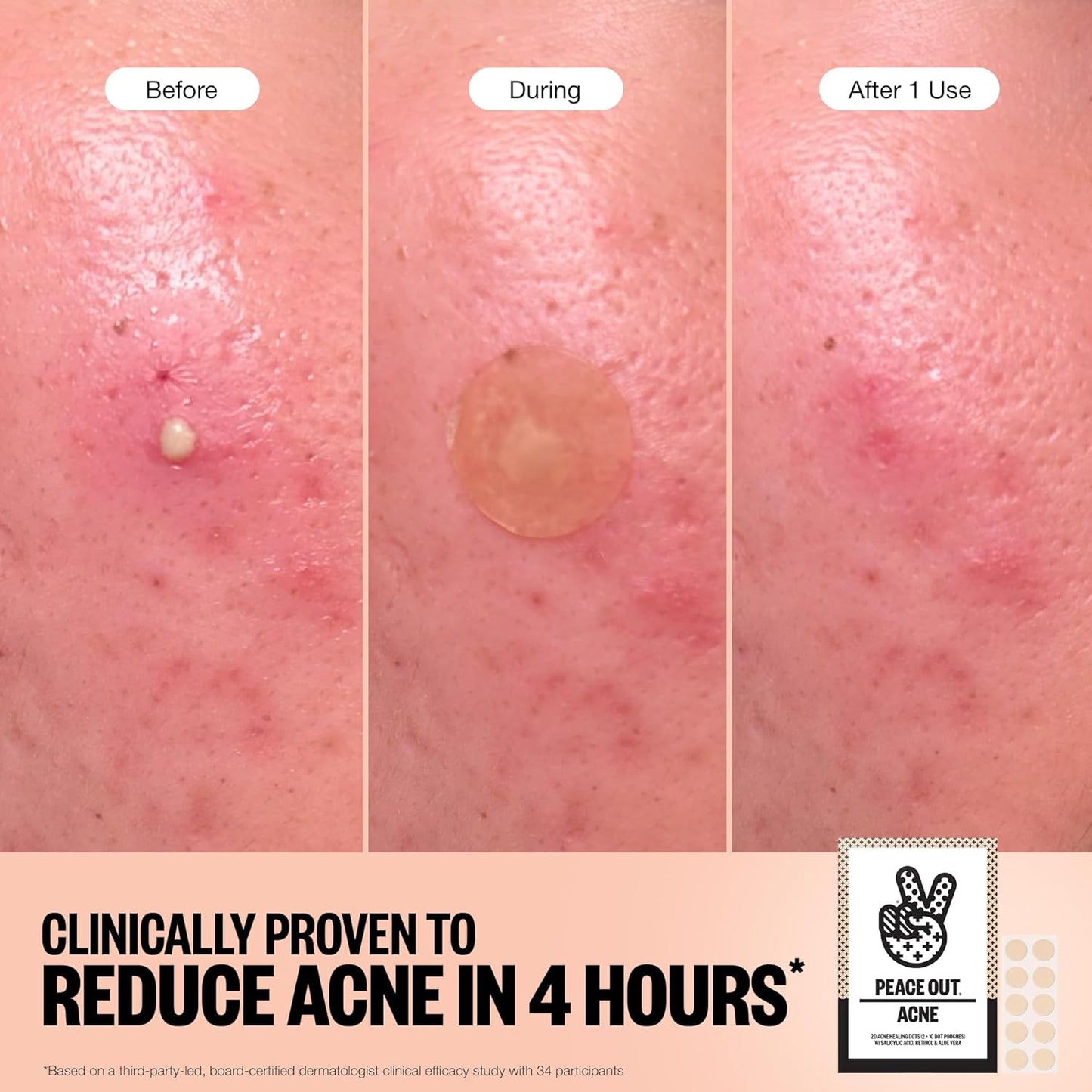 PEACE OUT Acne Healing Dots Helps Clear Blemishes Overnight, Fast Acting Hydrocolloid Pimple Patches for Breakouts with Salicylic Acid, Retinol and Aloe Vera, Award Winning Skincare Solution 60 Count