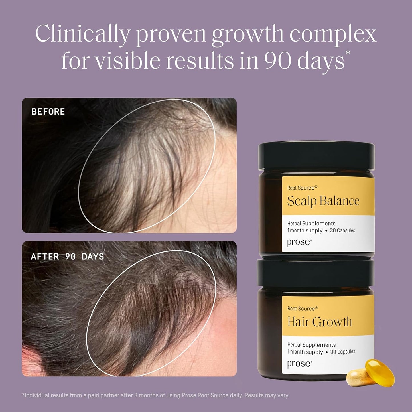 Prose Scalp Balance & Hair Growth Supplements, Scalp Relief, Clinically Proven Growth Complex for Visibly Fuller Hair in 90 Days, Vegan, Biotin, No Hormone Disruptors, Gluten Free, 1 Month Supply