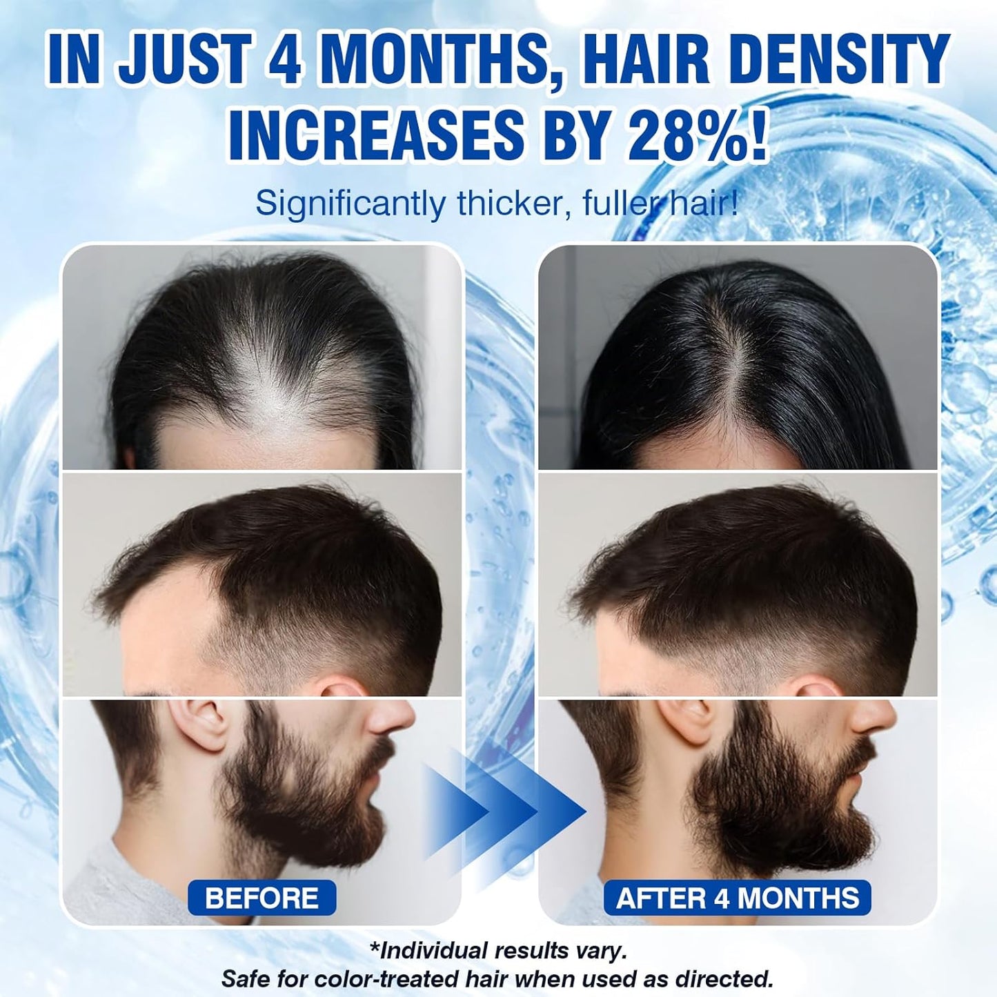 5% Minoxidil for Men and Women Hair Growth Spray Serum Minoxidil Biotin for Hair Beard Growth Prevent Hair Loss for Thicker Longer Fuller Healthier Hair 3 Bottles of 2oz