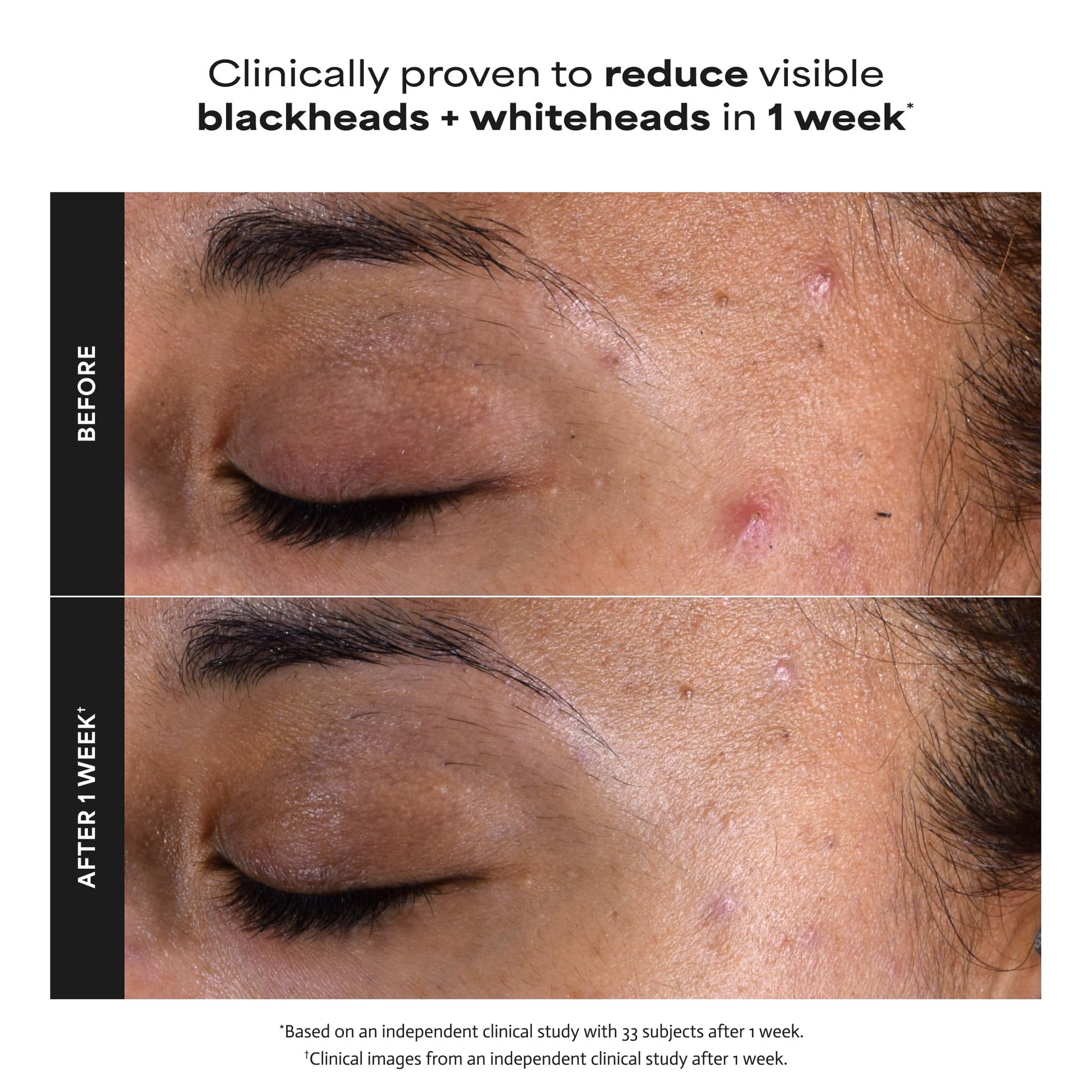 Paula's Choice SKIN PERFECTING 2% BHA Liquid Exfoliant, 4 Fl Oz