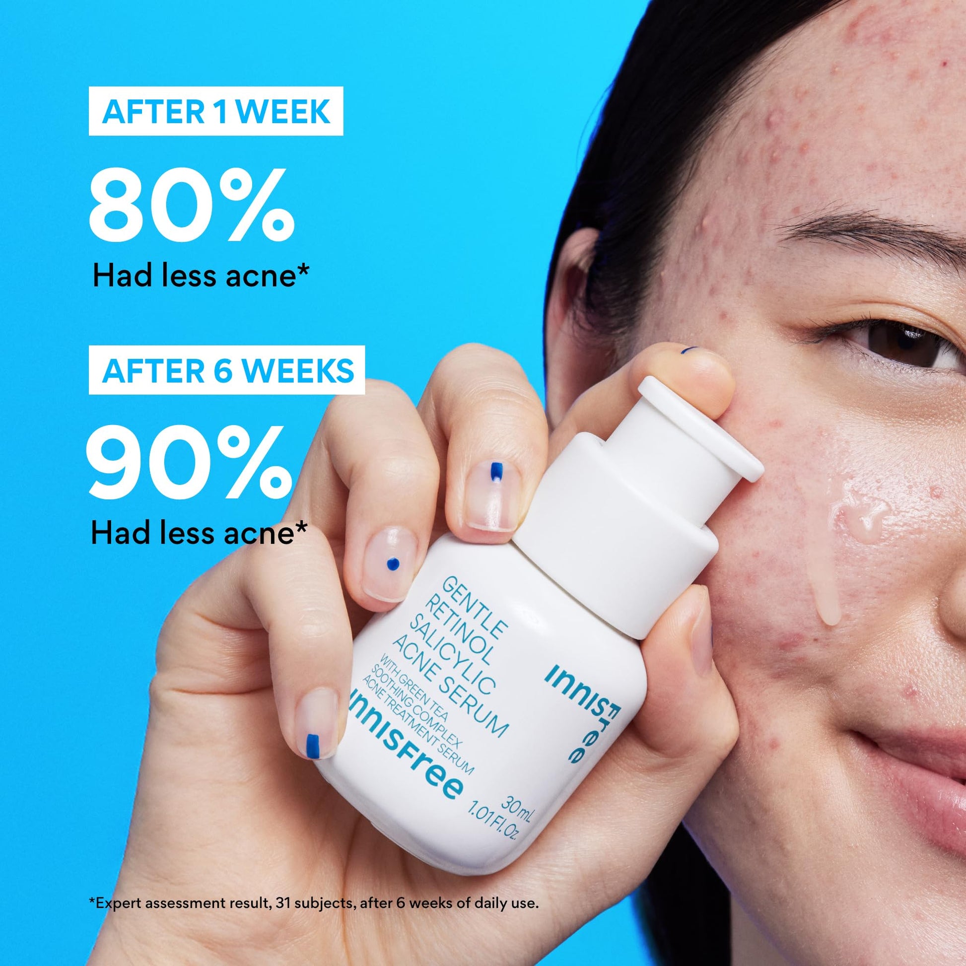innisfree Gentle Retinol Salicylic Acne Serum | Korean Face Treatment with Niacinamide and