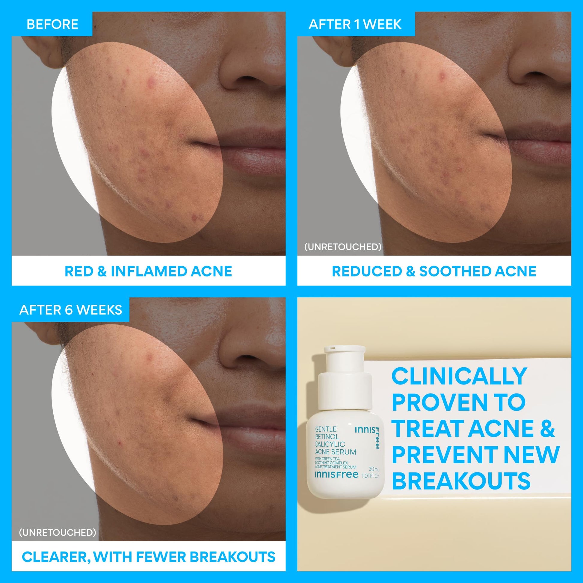innisfree Gentle Retinol Salicylic Acne Serum | Korean Face Treatment with Niacinamide and