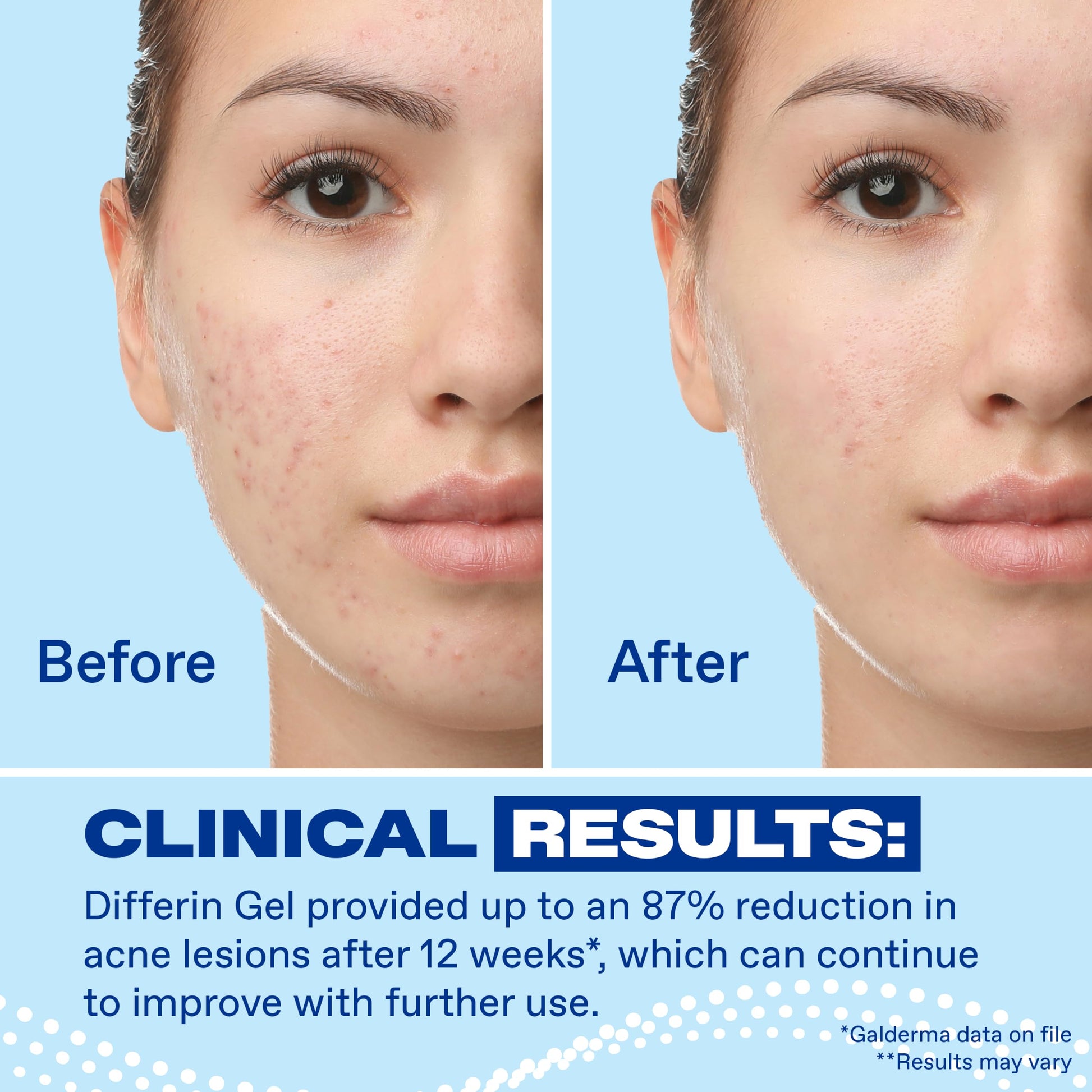 Differin Acne Retinoid Treatment Gel, 0.1% Adapalene, 45g Tube, 2ct