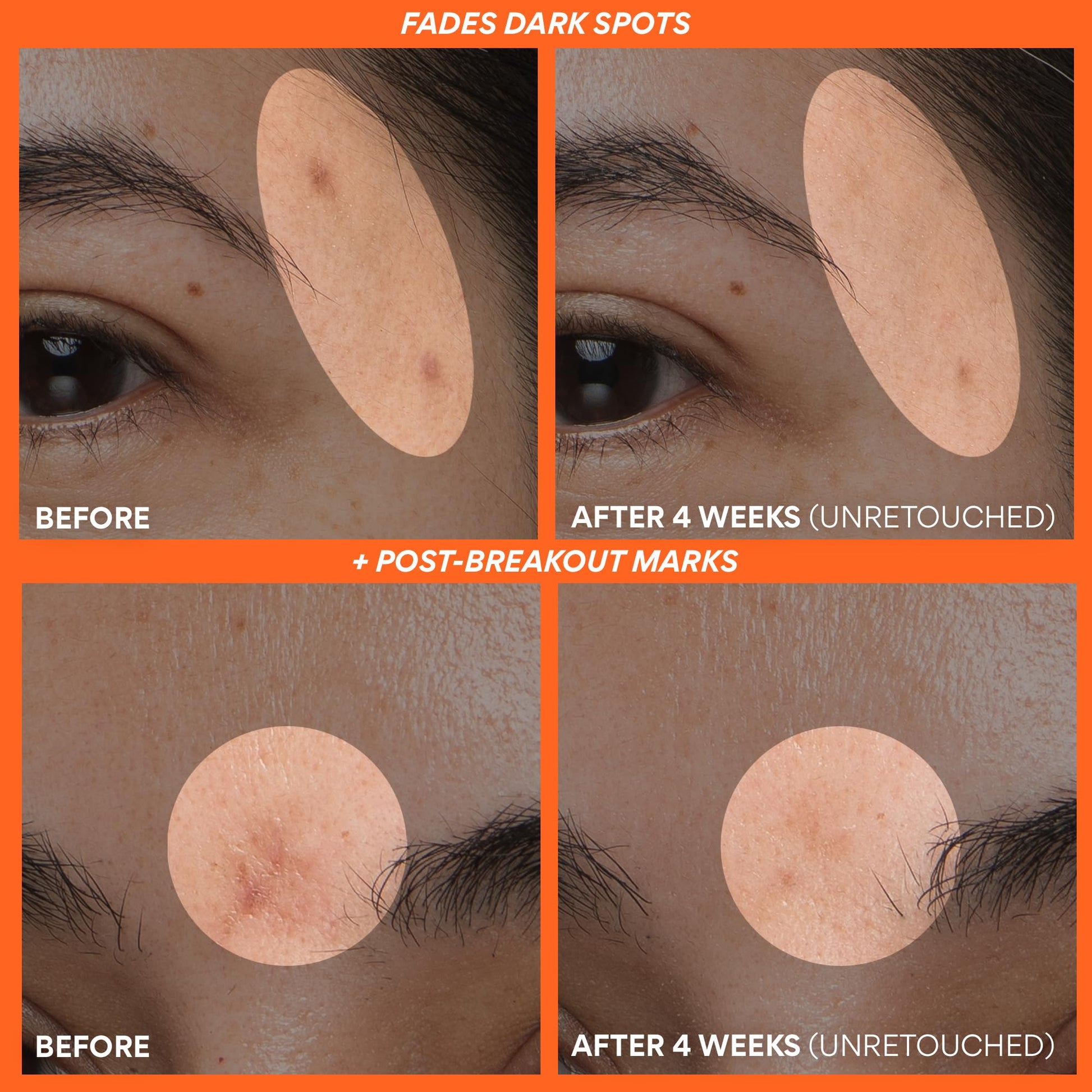 Innisfree Green Tea Enzyme Vitamin C Serum for Brightening | Sunspots, Post-Breakout Marks and Dark